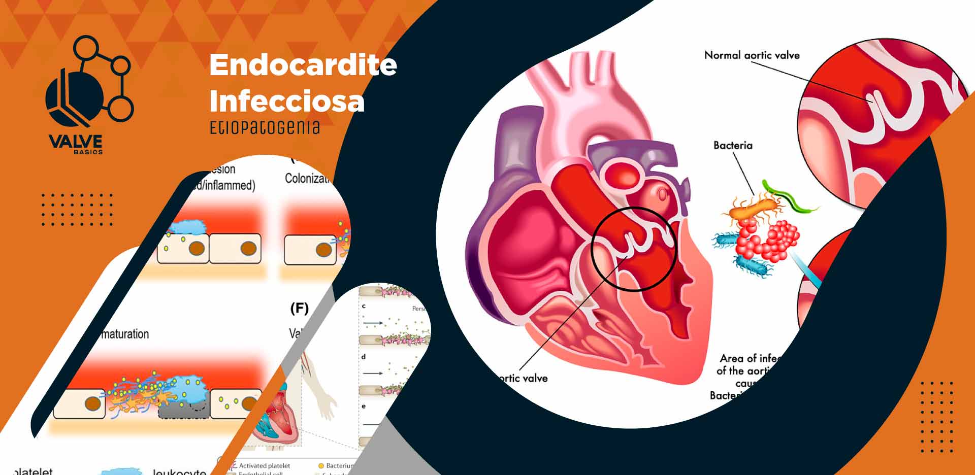 Endocardite Infecciosa - The Valve Club