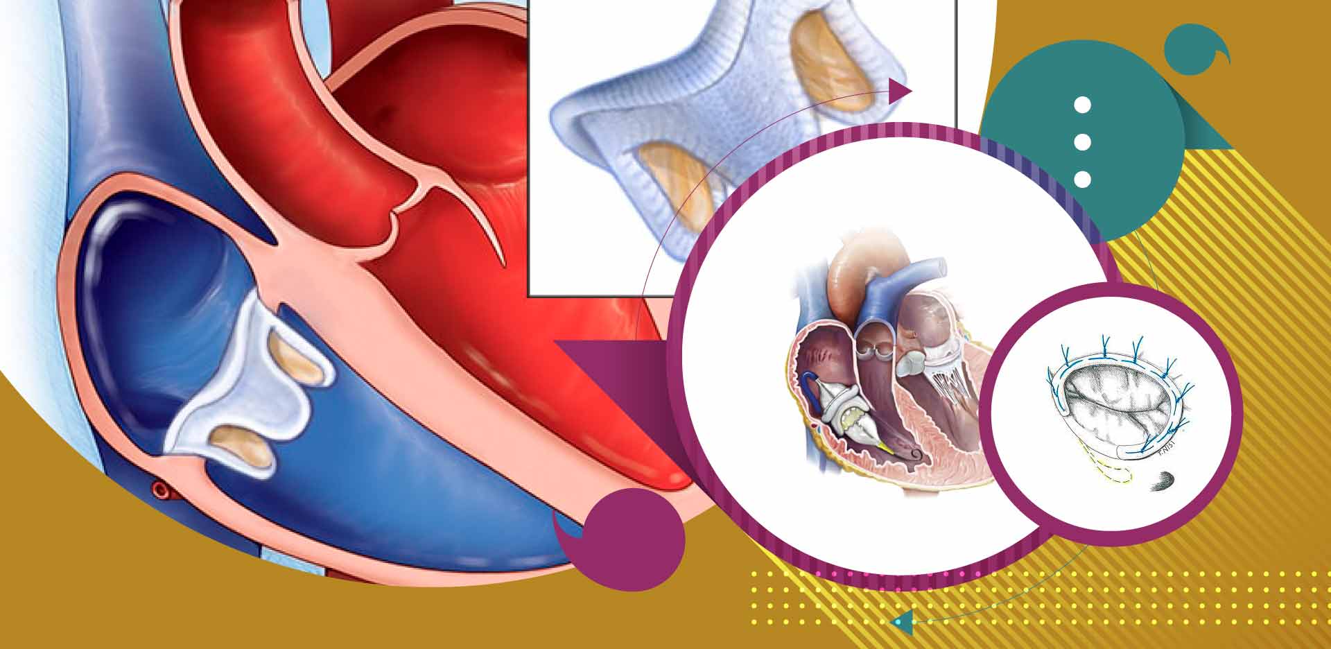 ValveinValve Tricúspide